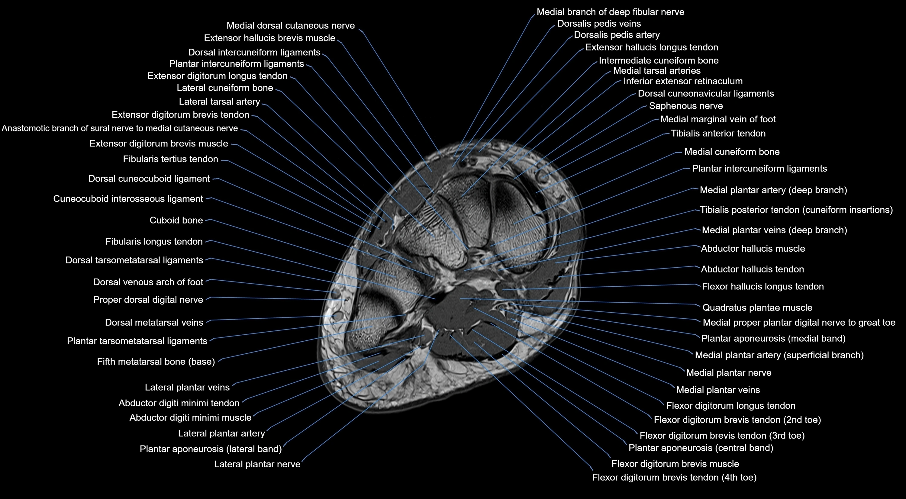 MRI mid foot coronal ligaments cross sectional anatomy 3T  radiology  image-img-00001-00023.webp